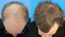 كيفية زراعة الشعر