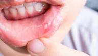 طرق علاج قرحة الفم طرق علاج قرحة الفم