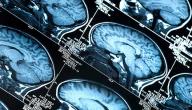 طرق علاج جلطة الدماغ طرق علاج جلطة الدماغ
