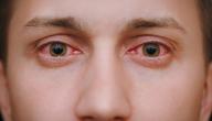 طرق علاج حساسية العين واحمرارها طرق علاج حساسية العين واحمرارها