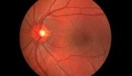 علاج تمزق شبكية العين علاج تمزق شبكية العين
