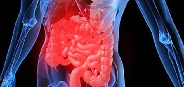 أعراض التهاب الأمعاء