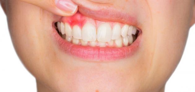 أعراض التهاب اللثة