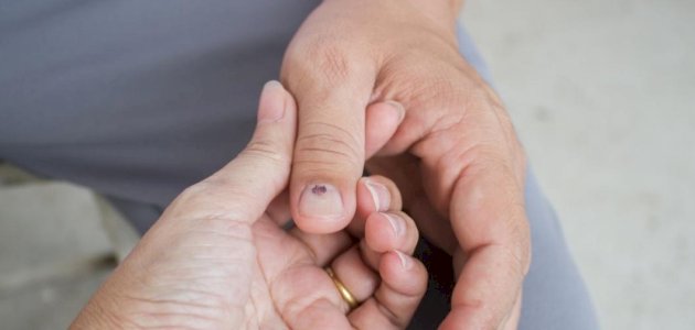 أسباب-ظهور-خط-أسود-على-الظفر/