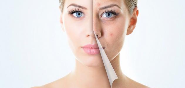 طرق إزالة آثار حب الشباب